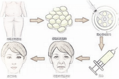 【自体脂肪面部填充】术后可以喝酒熬夜吗？