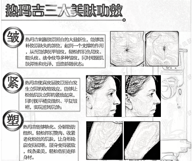 天津医院整形科热玛吉除皱果怎么样 可以维持多少年