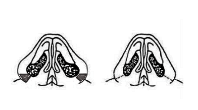 鼻翼肥大与外扩的解决方法——两种方法叠加果更好
