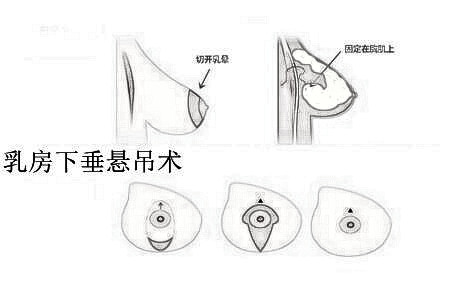 做乳房下垂矫正多少钱?