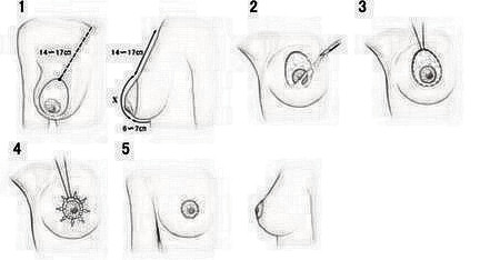 做乳房下垂矫正多少钱?