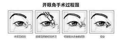 开内眼角价格一般多少钱?【手术费用问题】
