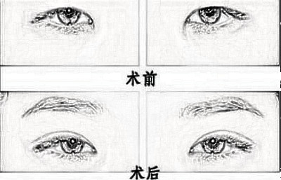 割双眼皮要多少钱?小编打听的各类双眼皮手术费用的情报!