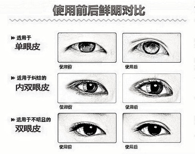 双眼皮微创手术多少钱?价格贵吗?