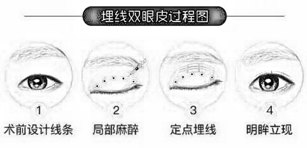 埋线双眼皮的价格原来这么便宜,太适合月光族了!