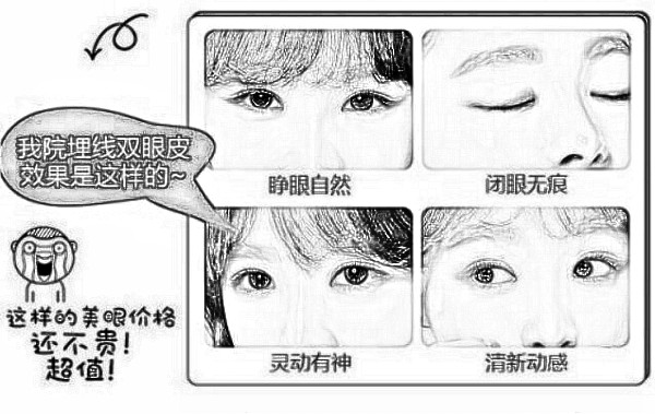 埋线双眼皮的价格原来这么便宜,太适合月光族了!