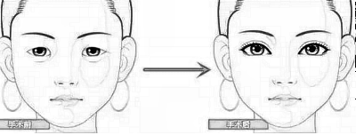 韩式微创双眼皮多少钱？做手术你应该准备这么多预算~