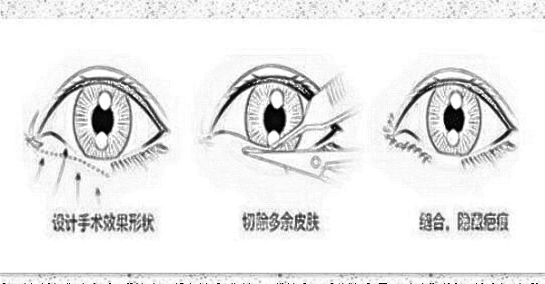 眼睑下至价格贵吗?大概需要多少钱?