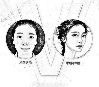 广州下颌角磨骨价格多少钱,有很多人动不动就上万了?