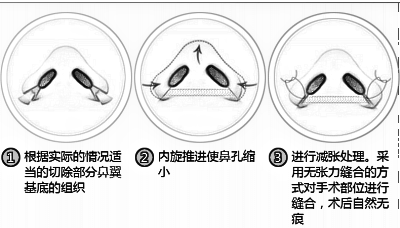 哈尔滨缩鼻翼手术价格是多少,听说价格浮动很大?