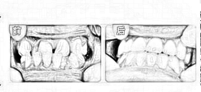 成都美容冠矫正龅牙多少钱，听说价格都很贵?