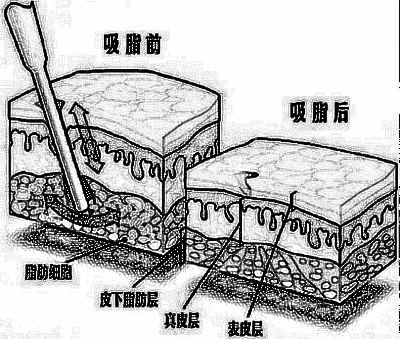 瘦脸较常见的方法你需要了解以下吗？