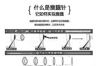 合肥打注射瘦腿瘦腿多少钱,价格和什么有关?