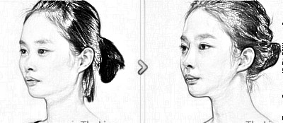 兰州假体隆鼻价格是多少钱,做一个鼻子这么贵?