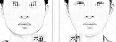 中山打一针注射瘦脸多少钱,什么影响了收费?
