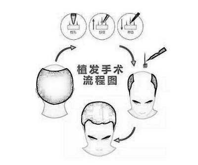 深圳要做种头发需要多少钱，为什么每个人价格不一样?