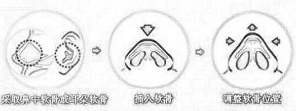 自体耳软骨隆鼻费用大概多少？受哪些因素影响？