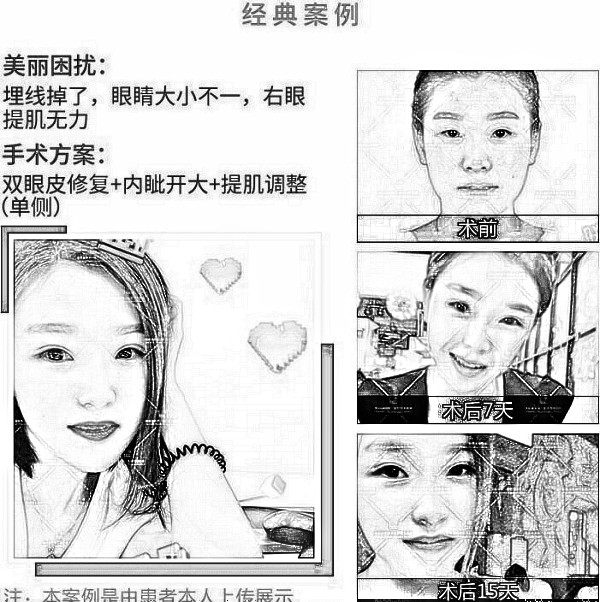 切双眼皮修复手术为何价格那么贵？看完就明白了！