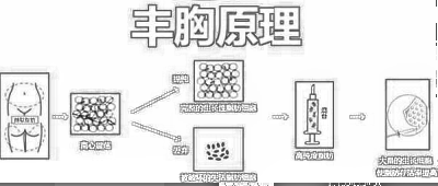 圣嘉新李朕丰胸多少钱?乳房圣手收费不便宜吧?