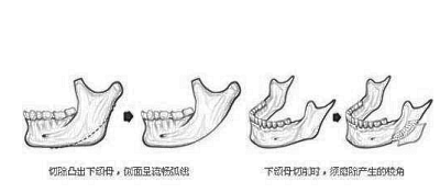 八大处滕利的手术费磨下颌角多少钱?价格差异因素详解