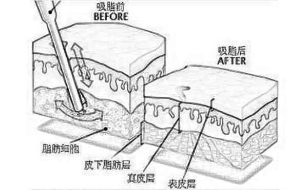 上海九院抽脂手术价格是多少?贵不贵喃?