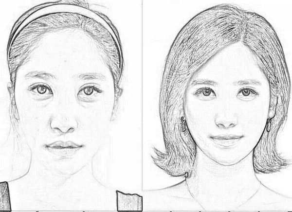 山东省立医院美容科~高峰自体脂肪丰面颊介绍分享~