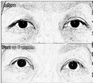 硬性隐形眼镜会导致眼睑下垂哦!