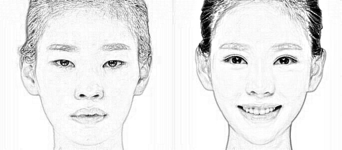 做了鼻整形手术恢复之后果不好怎么办?如何做修复手术?