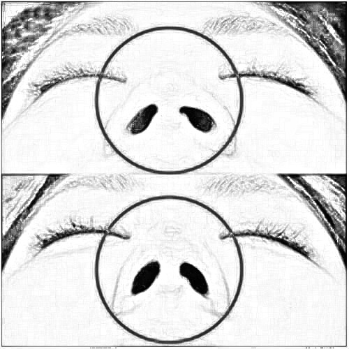 北京鼻头缩小多少钱 手术时一并改良鼻尖鼻翼问题