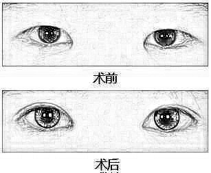 微创开眼角多少钱 同时可调节倒睫 一次完成眼部终生有魅力
