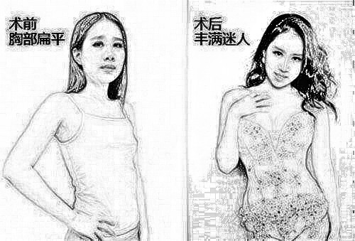 上海伯思立乳房下垂矫正用自体脂肪填充好吗