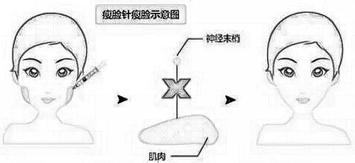 sl打完后该怎么护理