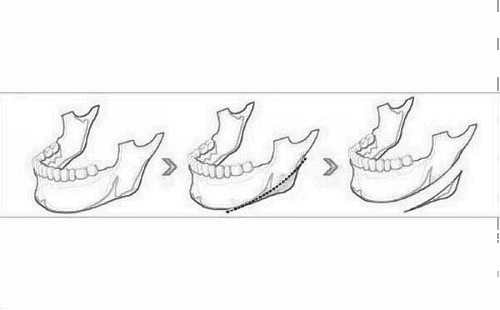 下颌角磨骨整形果怎么样 给你想要的迷人脸型