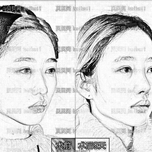 北京明会红医疗美容诊所晏晓青假体隆鼻介绍