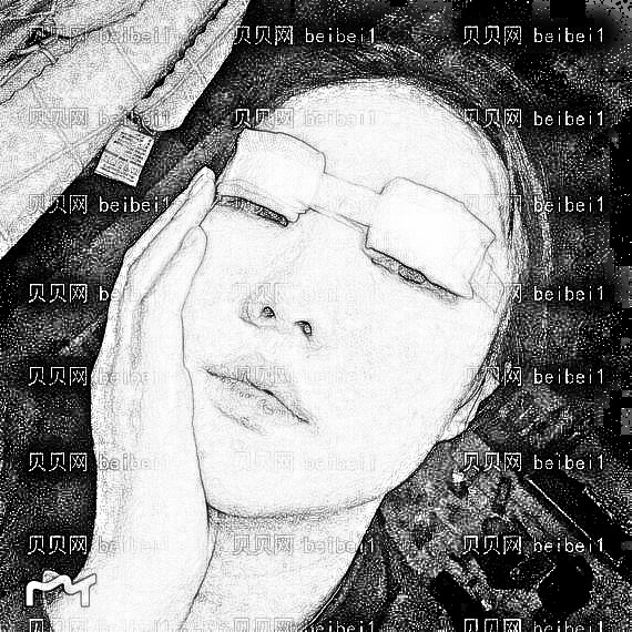 西安高一生医疗美容医院金磊全切双眼皮介绍