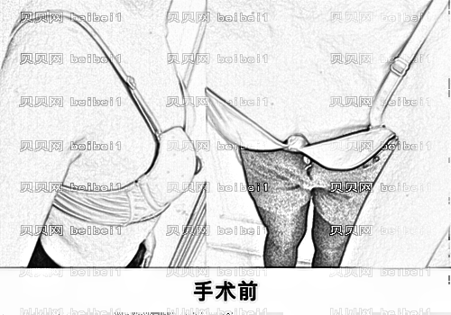 西安高一生医疗美容医院张林宏自体脂肪移植丰胸介绍
