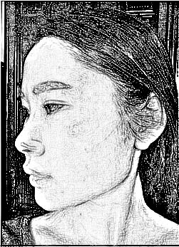 西安叶子医疗美容医院朱健康自体脂肪填充面部介绍