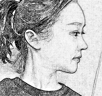 西安叶子医疗美容医院朱健康磨骨整形介绍