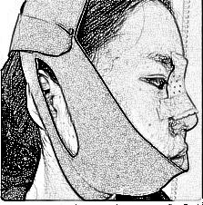 西安叶子医疗美容医院洪春磨骨介绍