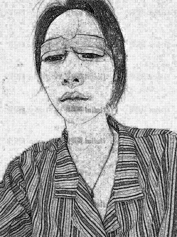 武汉一美整形美容医院汪利龙全切双眼皮介绍