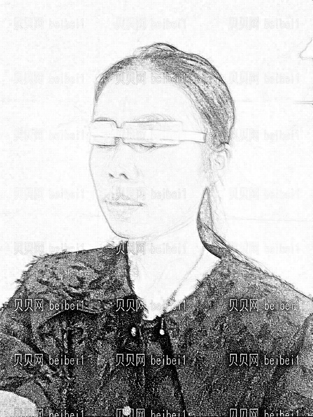 武汉壹加壹医疗美容医院王晓辉埋线双眼皮整形介绍