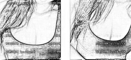 西安艺星医疗美容医院罗盛康医师自体脂肪隆胸介绍片较新分享_运动起来胸部很动感的哦