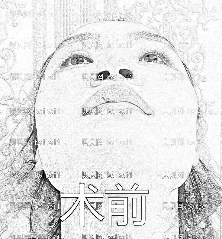 西安美立方医疗美容医院郭晶玻尿酸隆鼻介绍片较新分享_手术不大,果还是相当奈斯的~