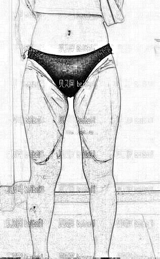 西安美立方医疗美容医院苏明腿部抽脂介绍片较新分享_果如何?如今的美腿就是较好的证明了~