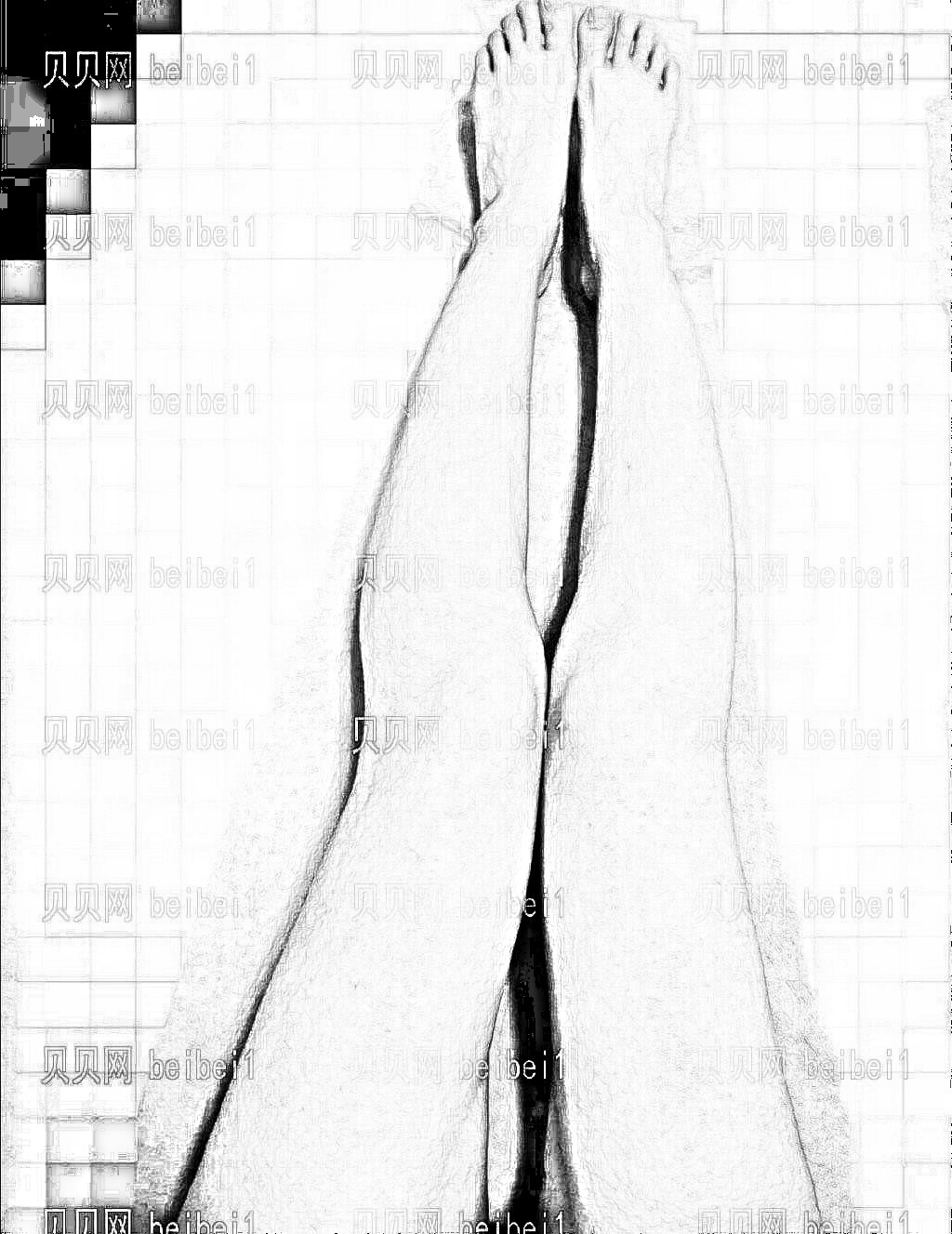 西安美立方医疗美容医院苏明腿部抽脂介绍片较新分享_果如何?如今的美腿就是较好的证明了~