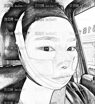 西安伊美尔医学美容门诊部王飞假体隆鼻介绍片较新分享_鼻子真的很而且很适合自己咯!