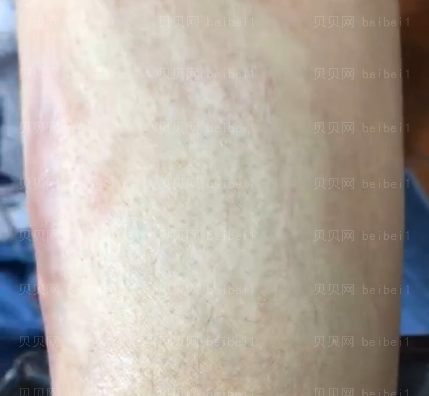 西京医院整形科马显杰手臂疤痕修复介绍片较新分享_不但疤痕淡化了皮肤较为白嫩了哦~