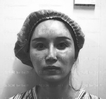 西京医院整形科彭湃注射隆鼻介绍片较新分享_美鼻给颜值加了不少分,还提升了气质呢!