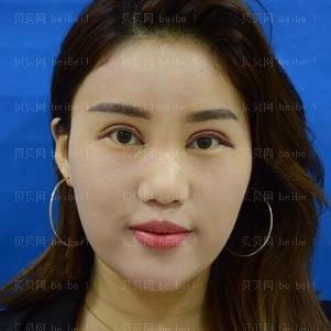 西京医院整形科彭湃切开双眼皮介绍片较新分享_眼睛恢复得毫无违和感了咯!