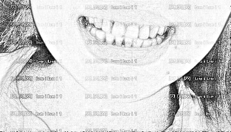 太原花妍年华医疗美容门诊部杨娜洁牙案例图片最新分享_术后牙齿不但没了结石，也白了很多啦！